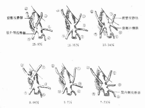 大隐静脉的属支类型(右侧)